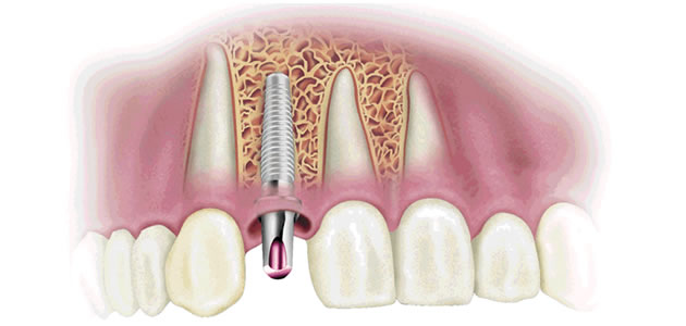 Centros Dentales Lucena Estepa Herrera - Montse Rojas - Ramn Luis Banchs - Dentista de Confianza - Ventajas Implantes Dentales