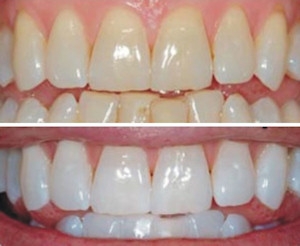 Centros Dentales Lucena Estepa Herrera - Montse Rojas - Ramón Luis Banchs - Dentista de Confianza - Blanqueamiento Dental