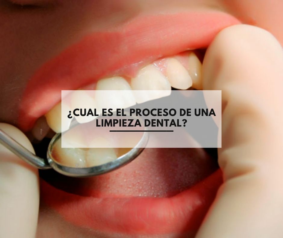 Conquistar obtener Antología Cual es el proceso de una limpieza dental? | Centros Dentales. Tus  dentistas de confianza en Estepa, Herrera y Lucena.