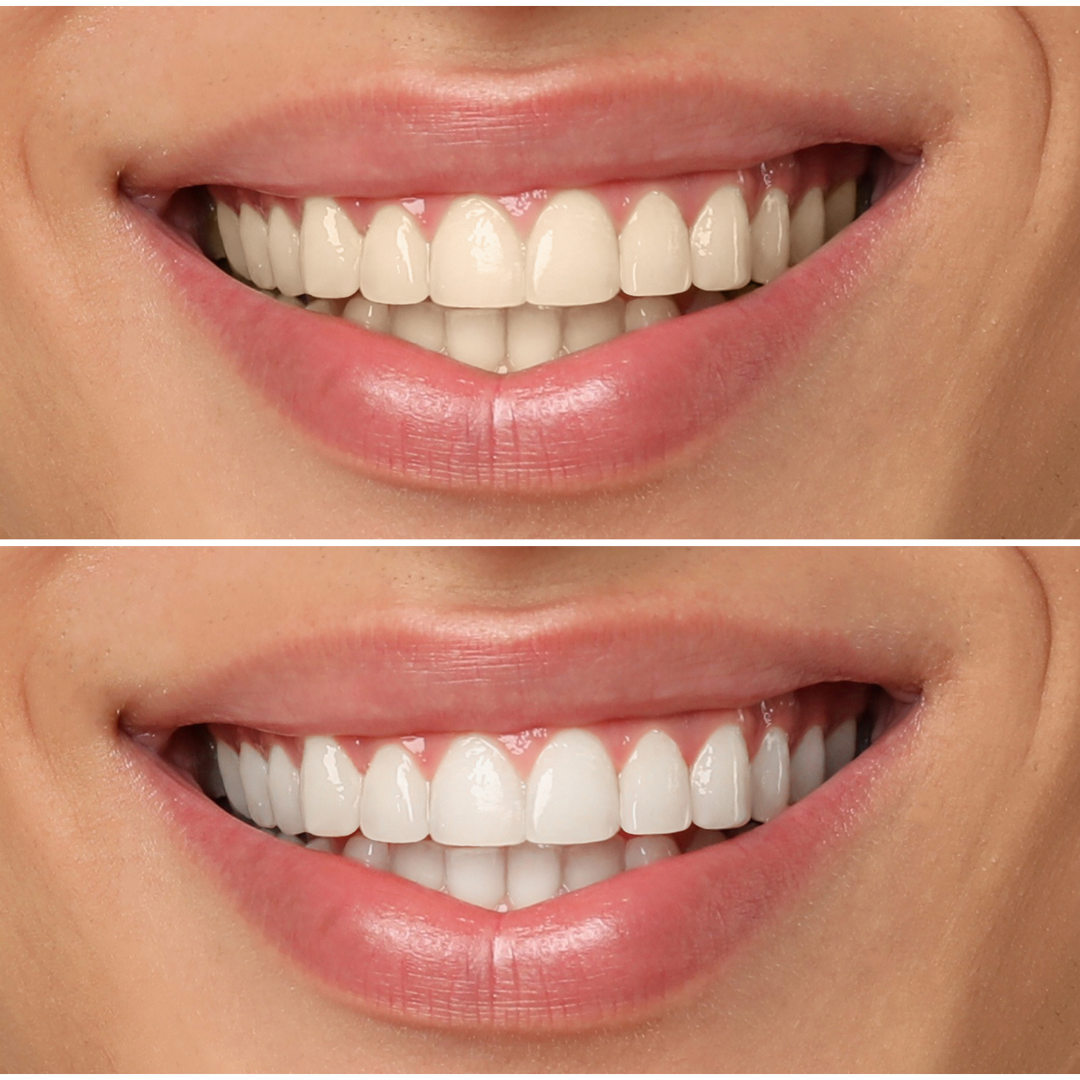 Tipos de blanqueamiento dental y cu�l elegir