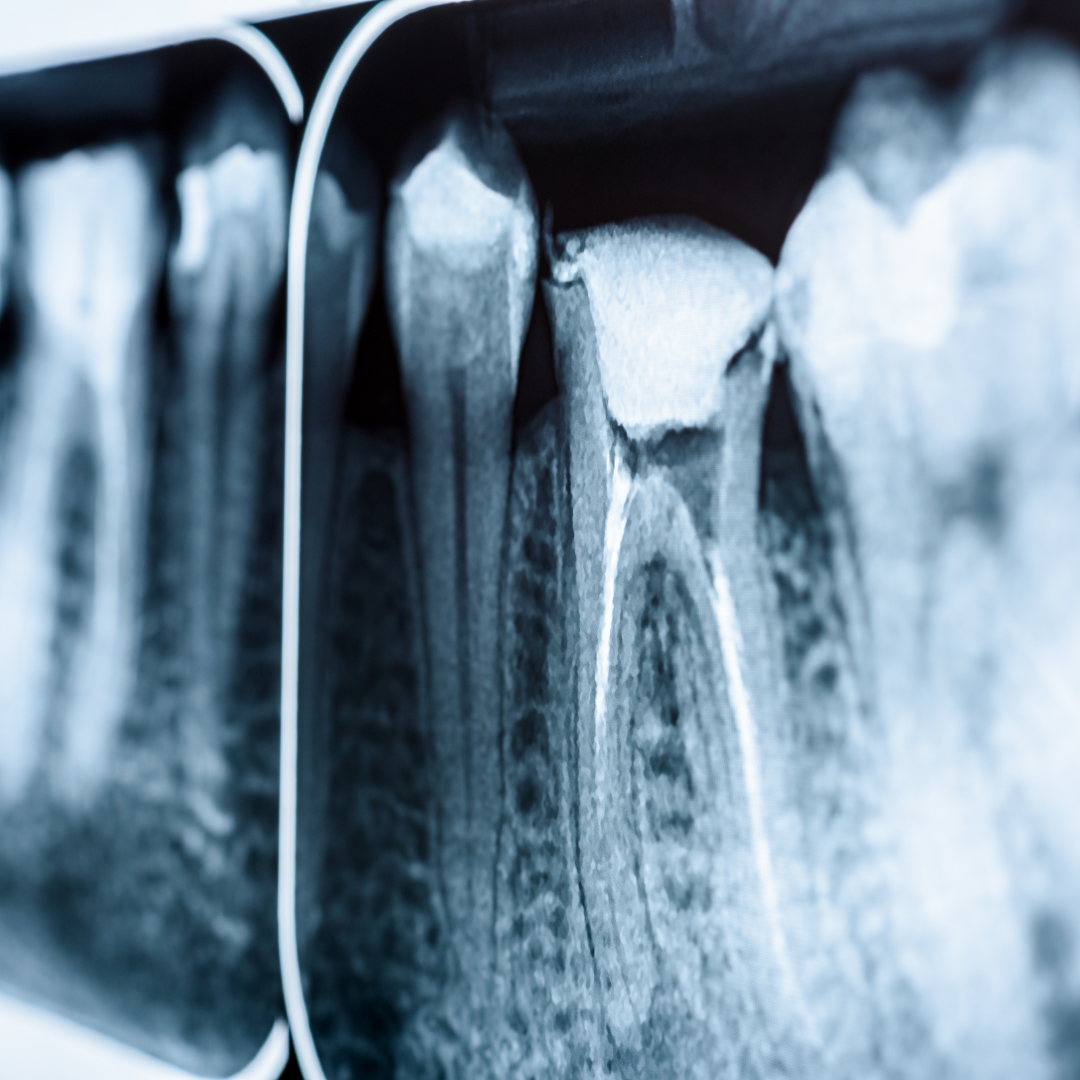 �Vale la pena una endodoncia? Todo lo que debes saber antes de elegir este tratamiento 
