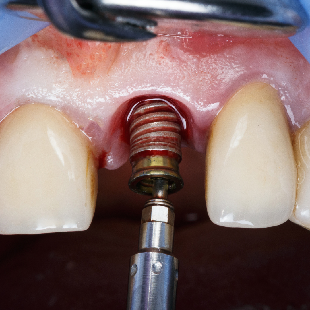 Complicaciones asociadas a los implantes dentales
